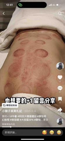 小獅子SPA 工作坊 - 刮痧走罐定罐-腰酸背痛待在冷氣房很適合