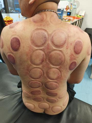 明清傳統整復推拿 - 深紅色屬勞損 略帶暗黑色屬舊傷