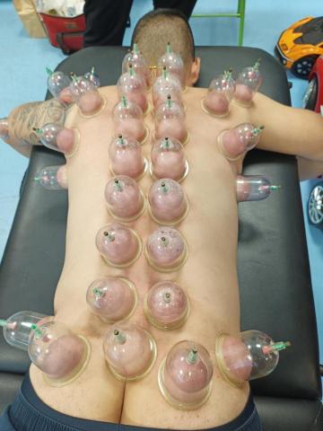 明清傳統整復推拿 - 拔罐放鬆經絡