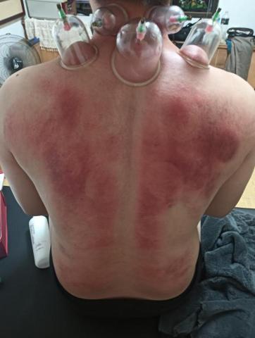 筋鬆小品 - 滑罐、拔罐