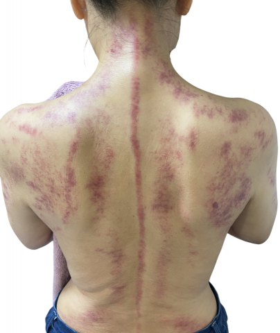 逸級刮痧-MGA科學刮痧 - 