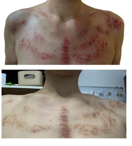 逸級刮痧-MGA科學刮痧 - 