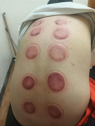 筋鬆小品 - 拔罐