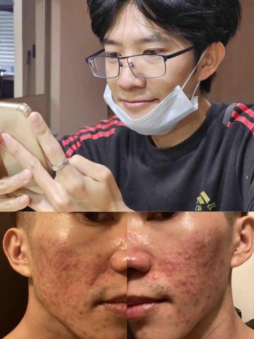 陳敬仁 - 痘痘粉刺照