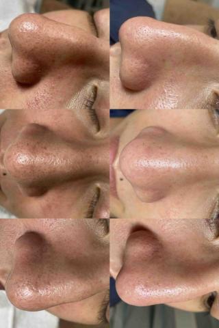 陳敬仁 - 無痛清粉刺