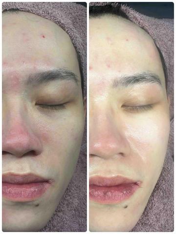 🔅靖雯撥筋護膚師🔅 - 水光課程之亮度無極限