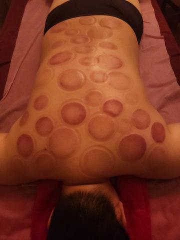 Liếm toi ủng ho guy en tan dung uyen - 客戶拔罐圖片