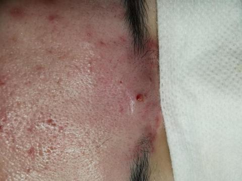 Ennia J - 清粉刺課程：卸妝／洗臉／去角質／清粉刺／鎮定／按摩／導入／敷臉