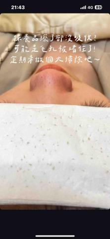 微笑美學😁 - 粉刺照