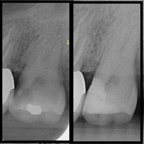 徐振傑 - 深度齲齒活髓治療