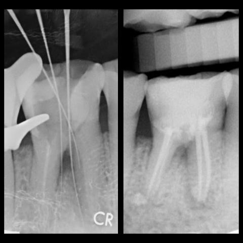徐振傑 - 困難根管治療