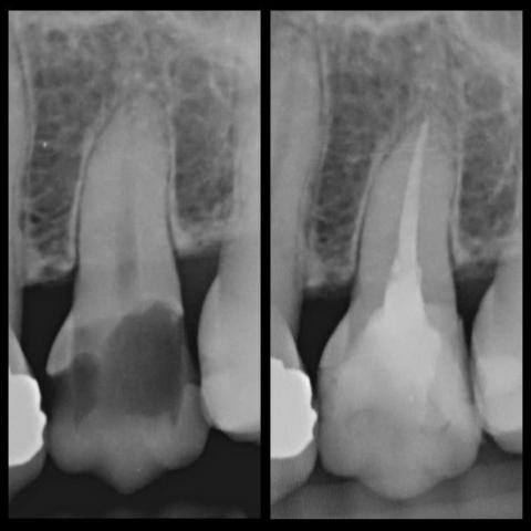 徐振傑 - 嚴重齲齒重建
