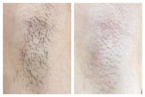 Ru.beauty - 腋下熱蠟除毛