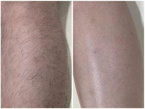 Ru.beauty - 小腿熱蠟除毛