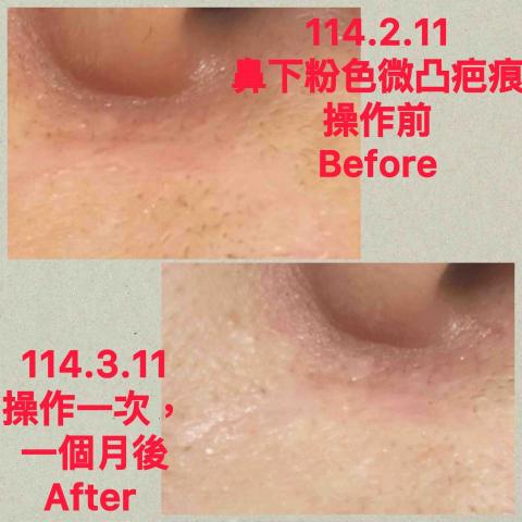 耳朵上的華爾滋 - 《再生永膚術》修復撫平疤痕 
操作一次前後對比照