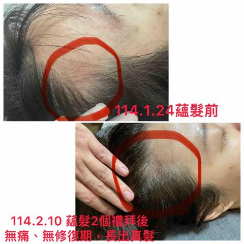 耳朵上的華爾滋 - 《蘊髮》操作一次，空洞地方重新長出頭髮