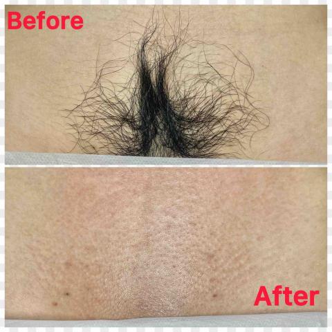 耳朵上的華爾滋 - 《熱蠟除毛》私密處熱蠟除毛前後對比照