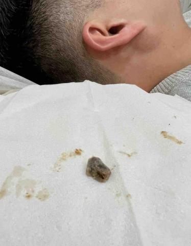 耳朵上的華爾滋 - 《採耳》處理10年耳結石