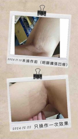 耳朵上的華爾滋 - 《再生永膚術》操作一次肥胖紋 前後對比照 