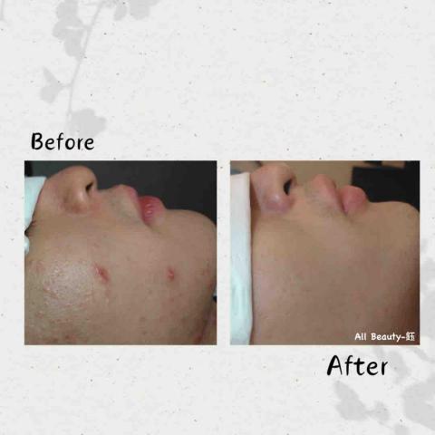 All Beauty｜中壢複合式美學空間・皮膚管理・熱蠟除毛 - 肌膚管理
