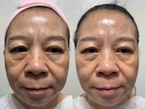 居家物理治療師 - 右邊做完海鑽石藻針煥膚，拉提效果明顯。
