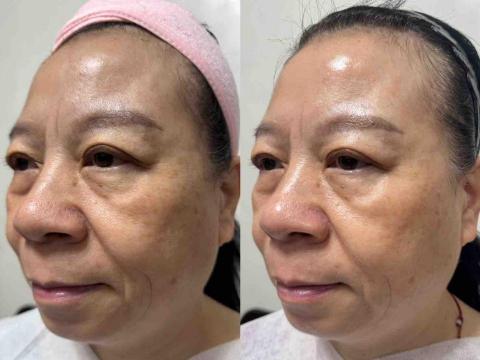 居家物理治療師 - 右邊做完海鑽石藻針煥膚，拉提效果明顯。