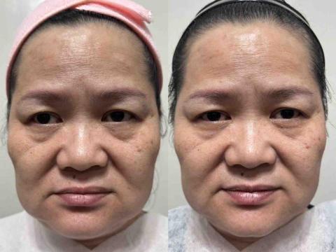 居家物理治療師 - 右邊做完海鑽石藻針煥膚，拉提效果明顯。