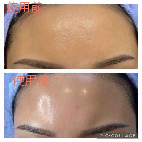 艾薇spa - 杏仁酸美白