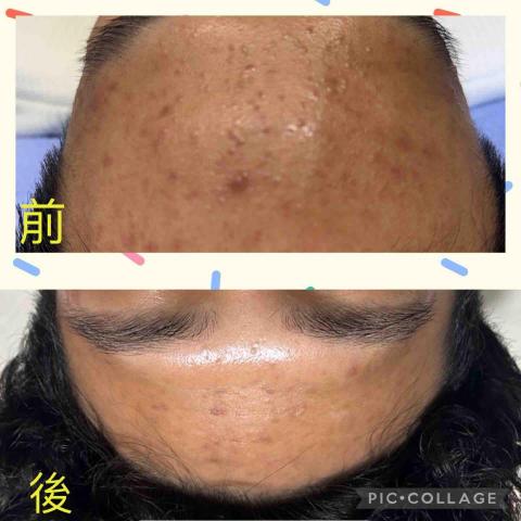 艾薇spa - 痘痘肌膚