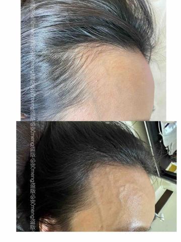 萌美個人工作室 - 上圖：施作前；下圖：施作後一個月