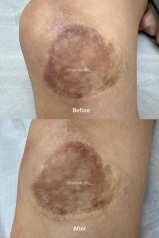 Chao Studio - 疤痕遮瑕