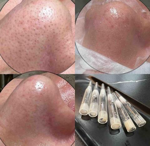 云禾美學 - 無痛清粉刺