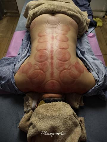 黃品彥 - 幫客人刮痧/拔罐的照片