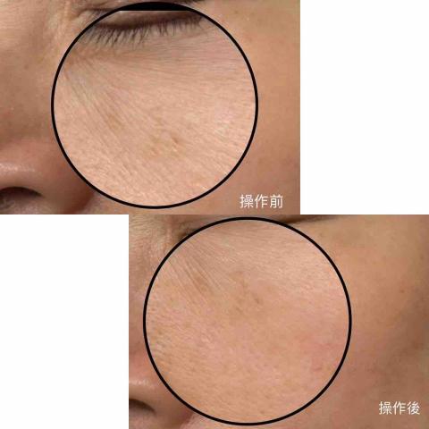 依蓉spa美學 - 矽晶前後