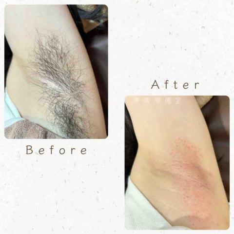 莘蒂療癒室 - 腋下熱蠟除毛，腋毛好多好濃想穿無袖出去玩怎麼辦，立刻預約熱蠟除毛，毛毛掰掰，除完才知道自己腋下肌膚嫩嫩的