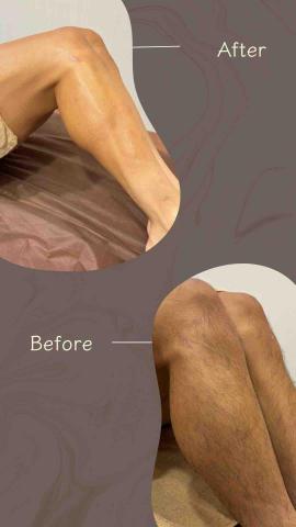 莘蒂療癒室 - 小腿熱蠟除毛，舞蹈表演老師三天後要演出，立刻來預約除麼，馬上乾淨