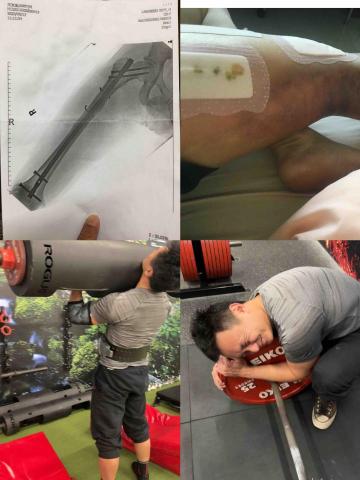 阿翔教練（謝翔宇）桃園 | 中壢 | 青埔 - 學生 傷後復健成功案例（腿斷