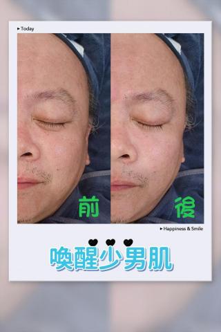 馨芩美顏 - 法令紋變淡
誰說只有女生怕，男生也想要英俊的臉龐?