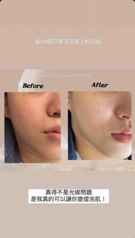 賴佳伶 - 撥筋對比圖