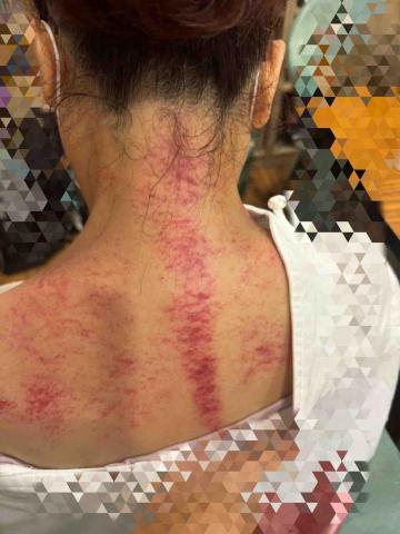 呂明訓 - 肩頸 呂明訓 - 肩頸