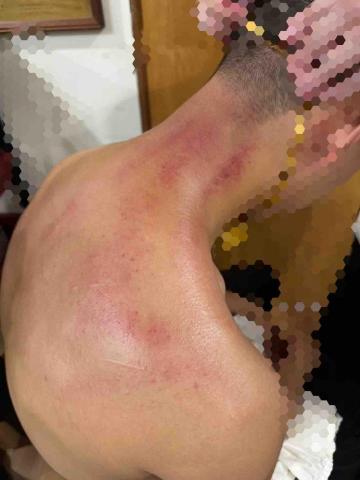 呂明訓 - 肩頸 呂明訓 - 肩頸