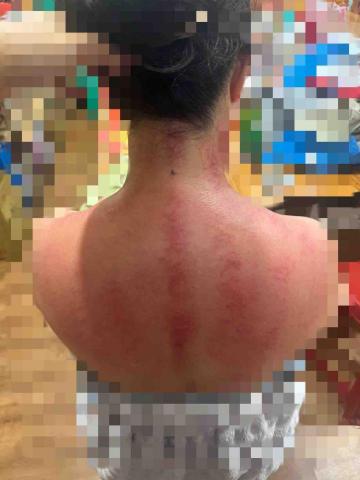 呂明訓 - 肩頸 呂明訓 - 肩頸