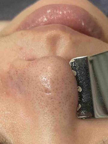 AH美容美體SPA美學館 - 毛孔淨化儀