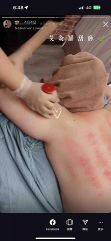 伊嬁按摩工作室 - 客製化艾灸罐刮痧