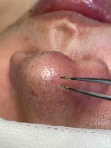 AH美容美體SPA美學館 - 手工清粉刺