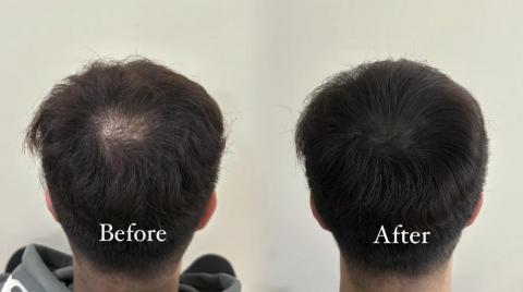 曦妍美學 - 男生髮旋填補