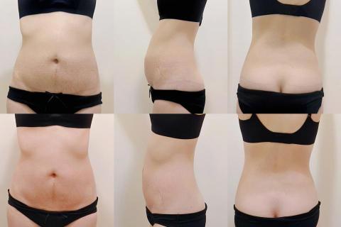 洪欣怡 - 腹直肌修復前後