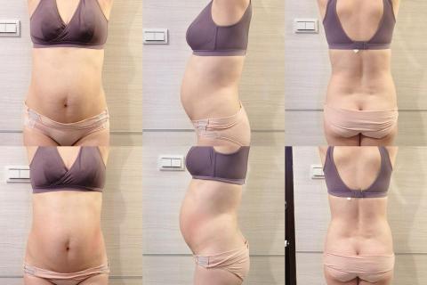 洪欣怡 - 腹直肌修復前後