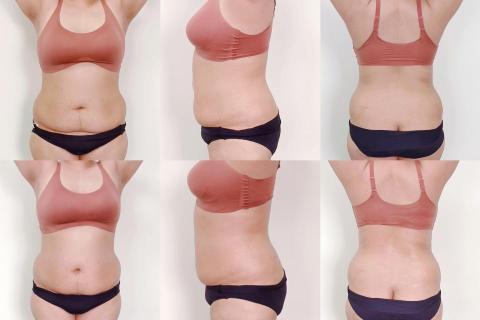 洪欣怡 - 腹直肌修復前後