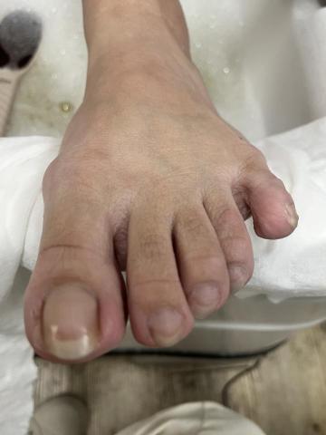 手足之美 - 銀行姐姐保養前